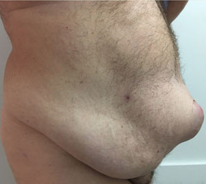 abdominoplasty-with-neo-umbilicus-before-2
