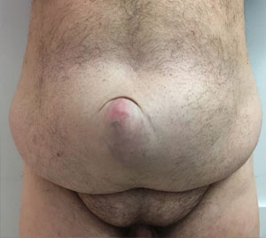 abdominoplasty-with-neo-umbilicus-before