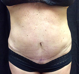 abdominoplasty_s1_after