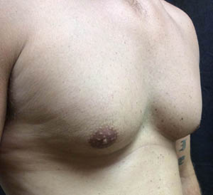 chest1-before