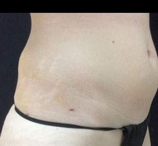 hiproll-smartlipo-after-2