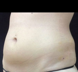 hiproll-smartlipo-after